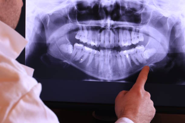 Best Emergency Wisdom Teeth Removal in Randallstown, MD
